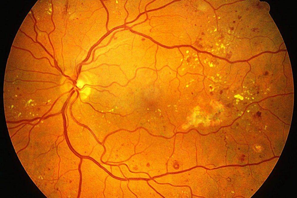 Diabetic Retinopathy: The Silent Vision Thief You Don’t See Coming