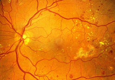Diabetic Retinopathy: The Silent Vision Thief You Don’t See Coming