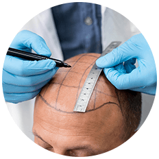 Hair Transplant